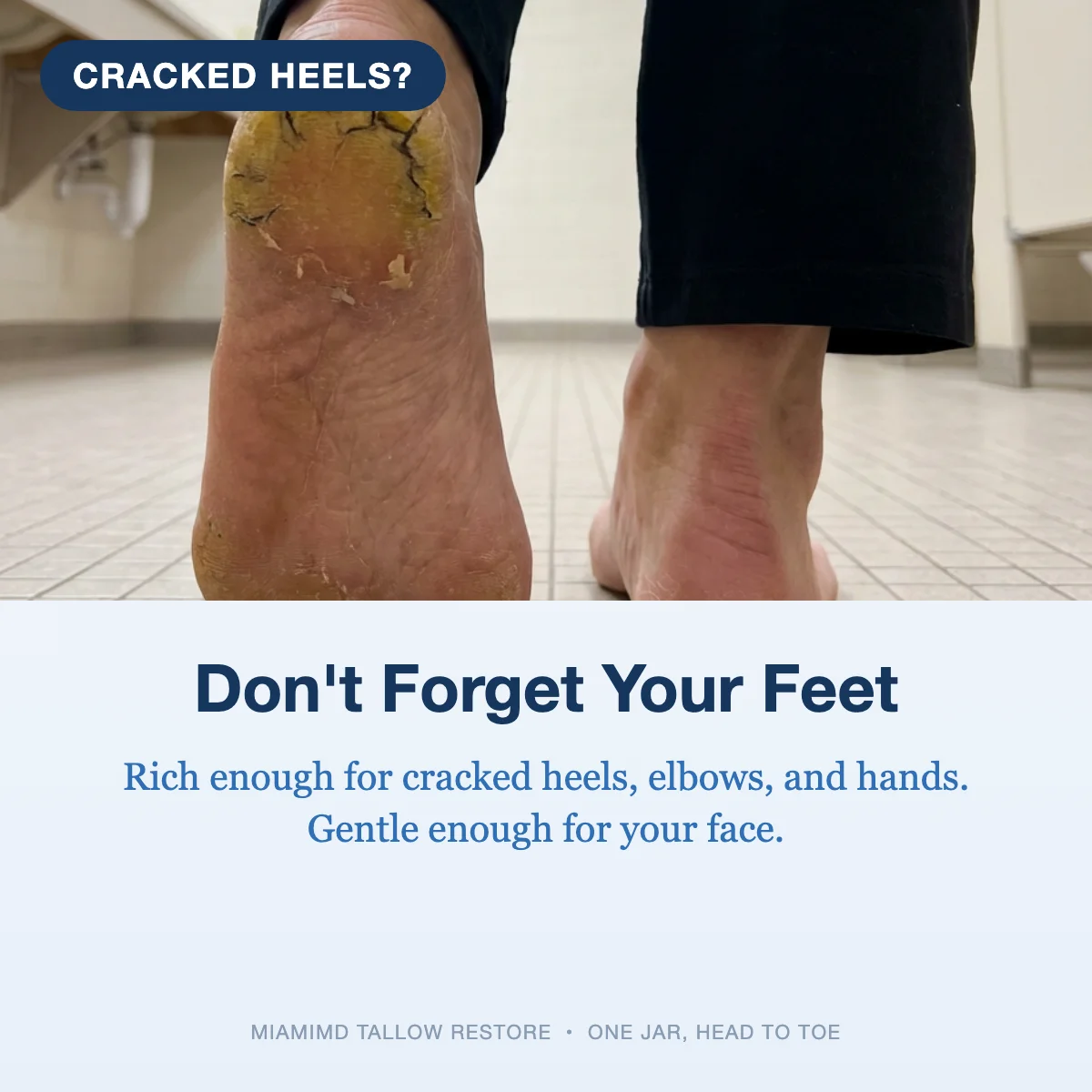 Tallow Restore on cracked heels