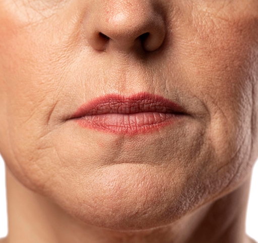 Mouth wrinkles