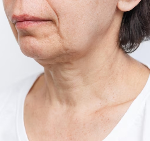 Saggy jowls