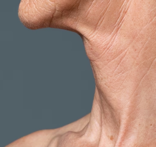 Turkey neck