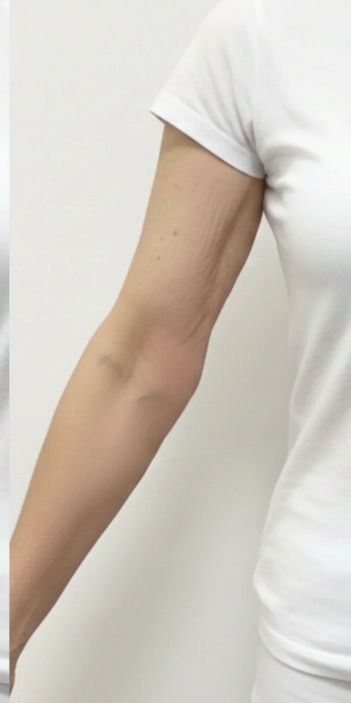Firmer upper arm after Advanced Crepe Fix