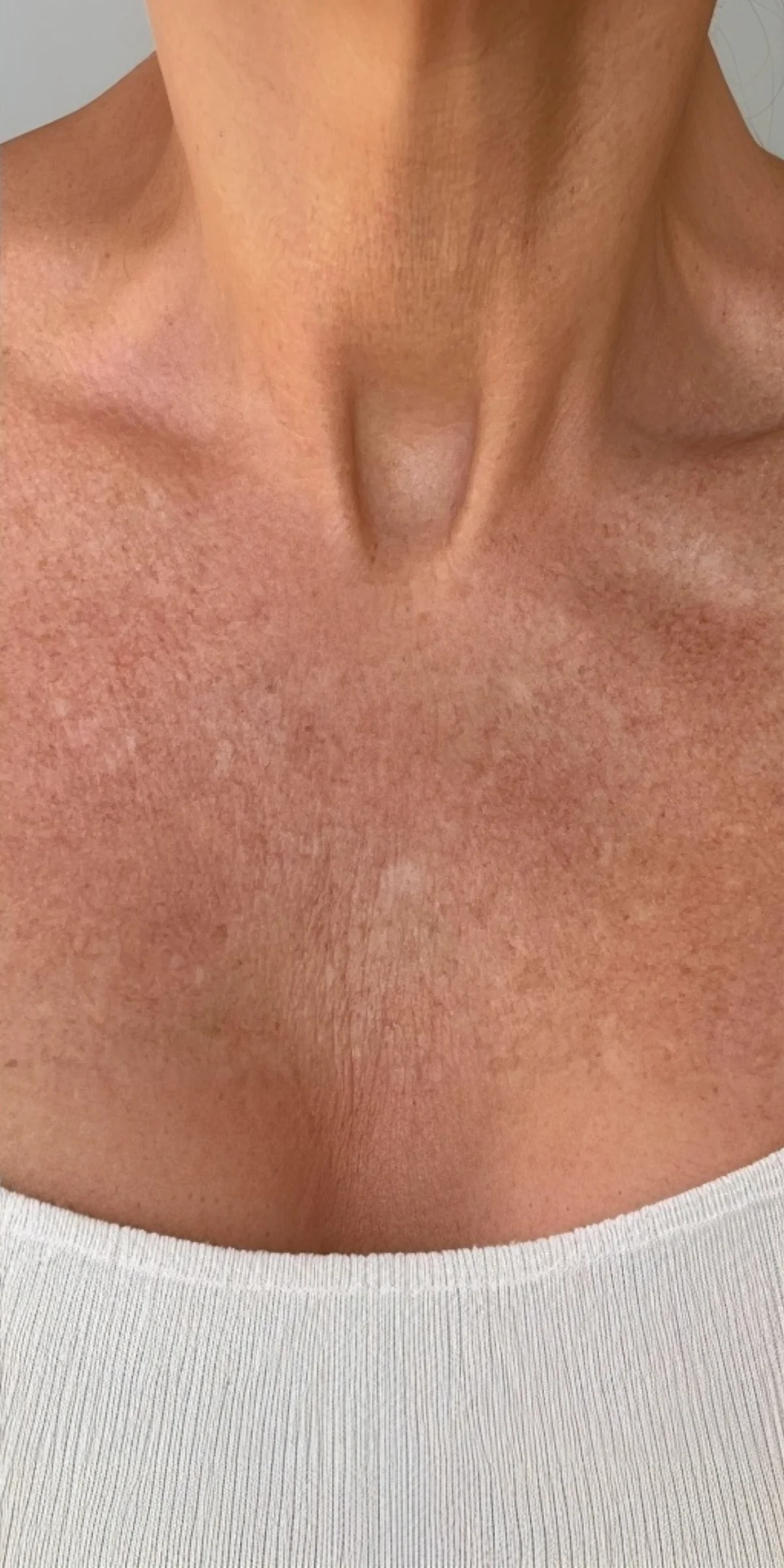 Smoother chest after Advanced Crepe Fix