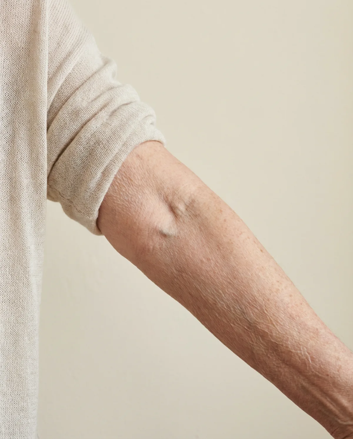 Forearm before