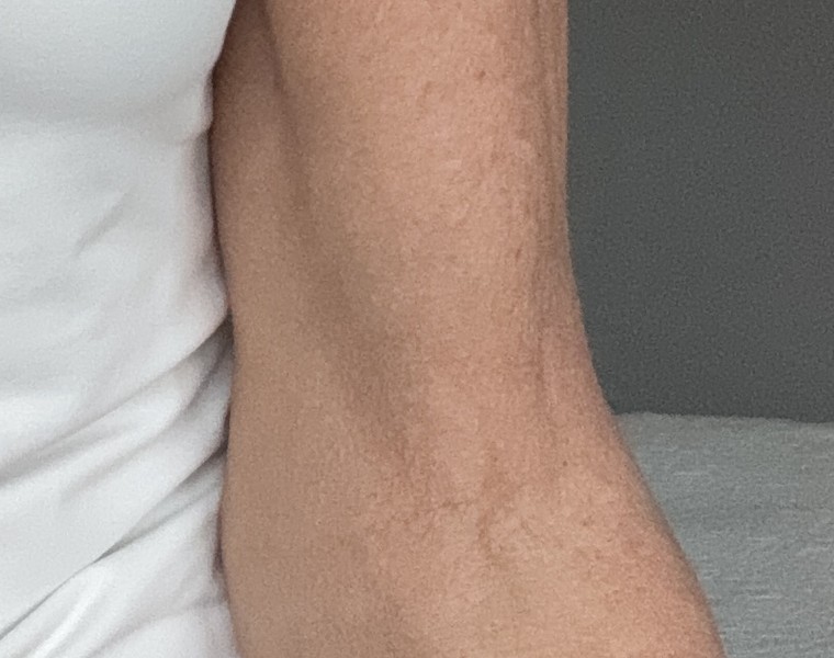 Arm after