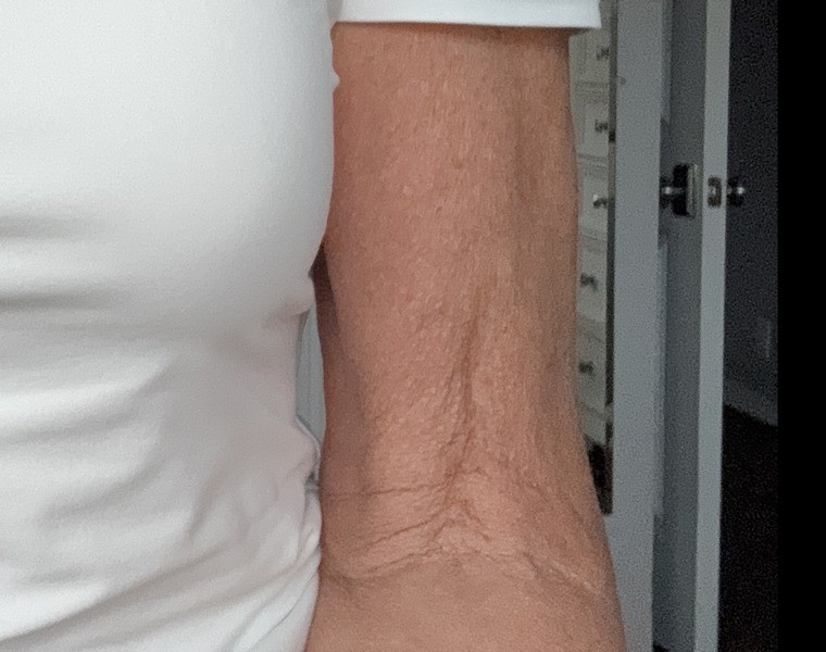 Arm before